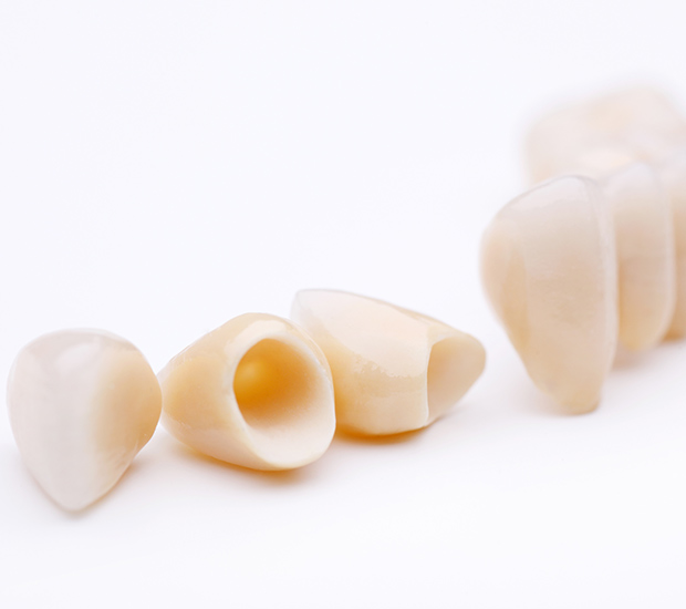 San Francisco Dental Crowns and Dental Bridges