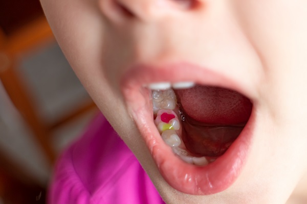 When Might A General Dentist Recommend A Dental Filling?