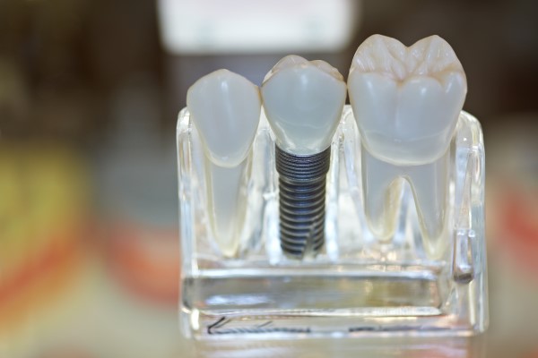 Dental Implants San Francisco, CA