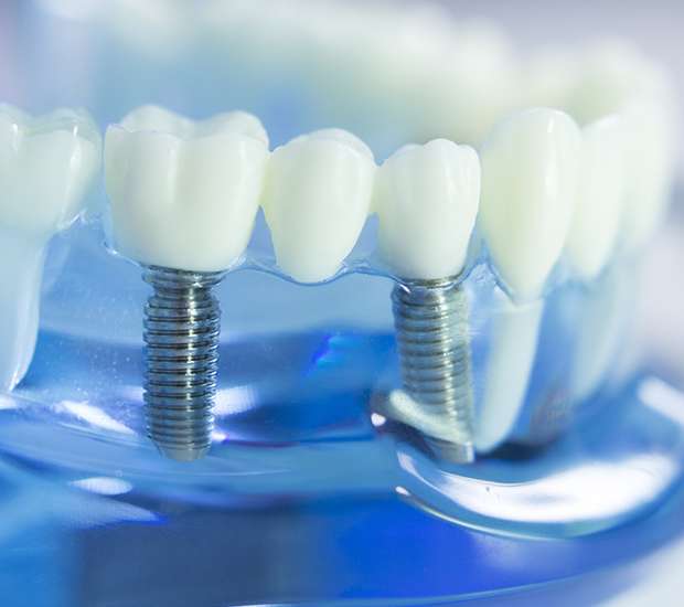 San Francisco Dental Implants