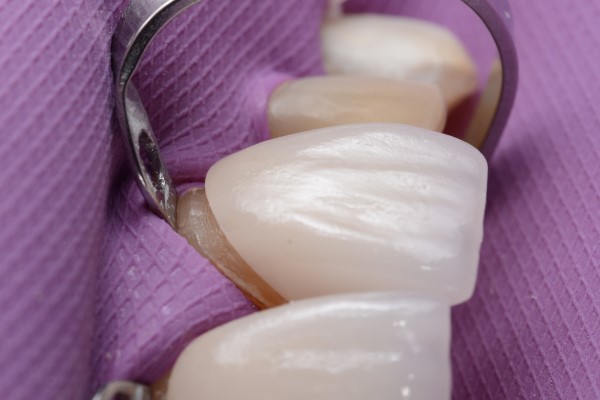 How To Determine If You Are A Candidate For Dental Veneers