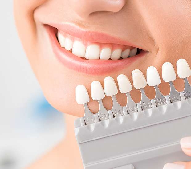 San Francisco Dental Veneers and Dental Laminates