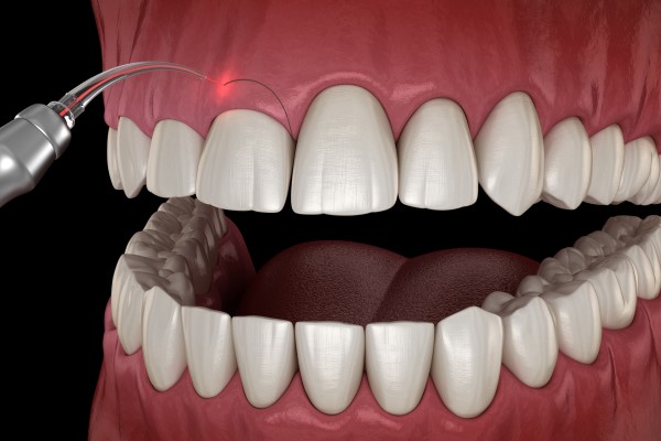 Laser Dentistry Vs  Traditional Dentistry