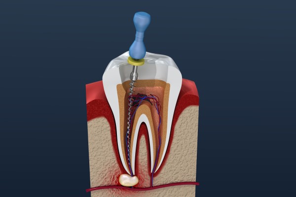 A Root Canal Can Save Your Damaged Tooth