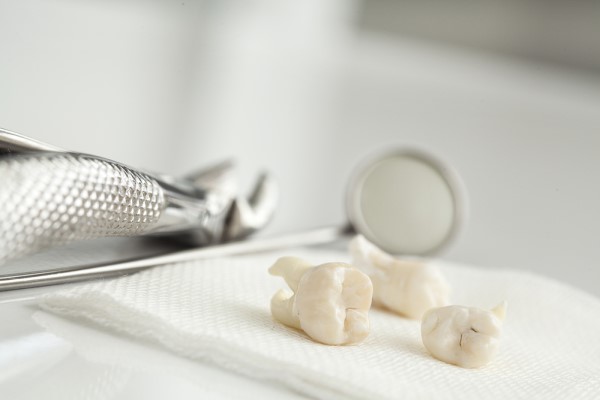 When You Should Get A Wisdom Tooth Extraction